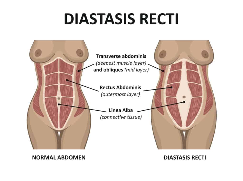 Identifying Diastasis Recti and how to correct it